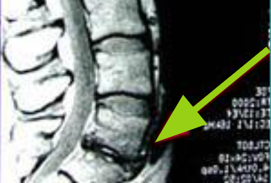 five-conditions-that-may-require-lumbar-spine-surgery