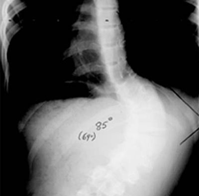 spine-disorders-diagnosing-common-deformities