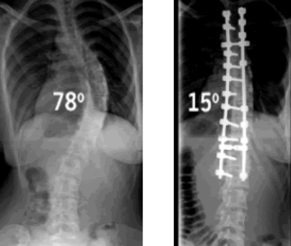 the-pros-and-cons-of-surgeries-for-scoliosis