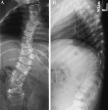 types-of-scoliosis